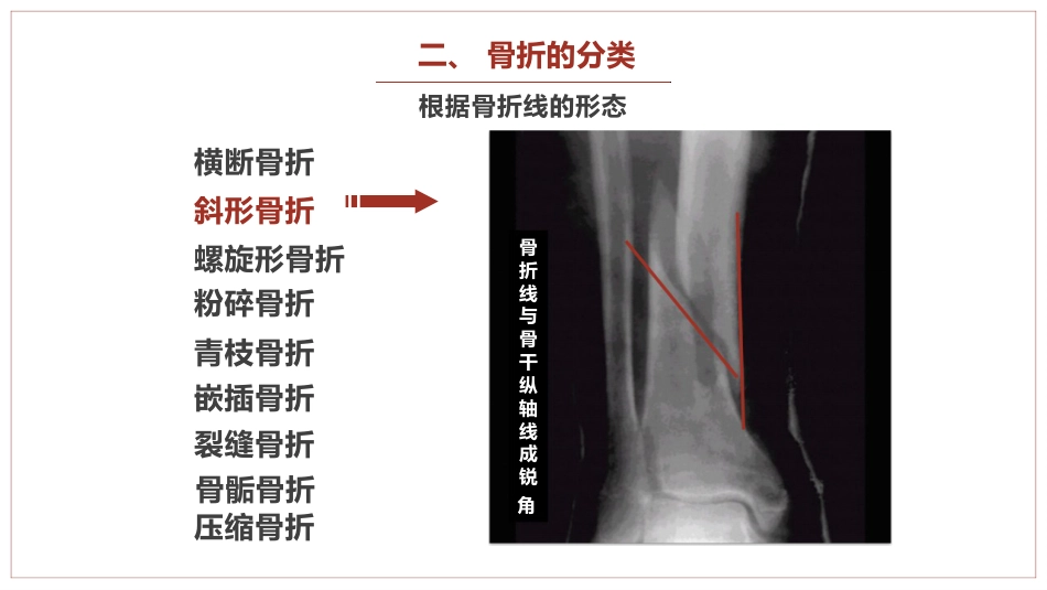 中医骨伤科学骨折概论临床知识学习课件PPT_第8页