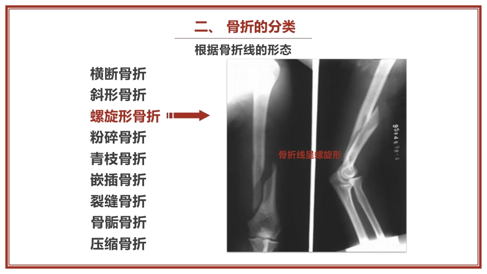 中医骨伤科学骨折概论临床知识学习课件PPT_第9页