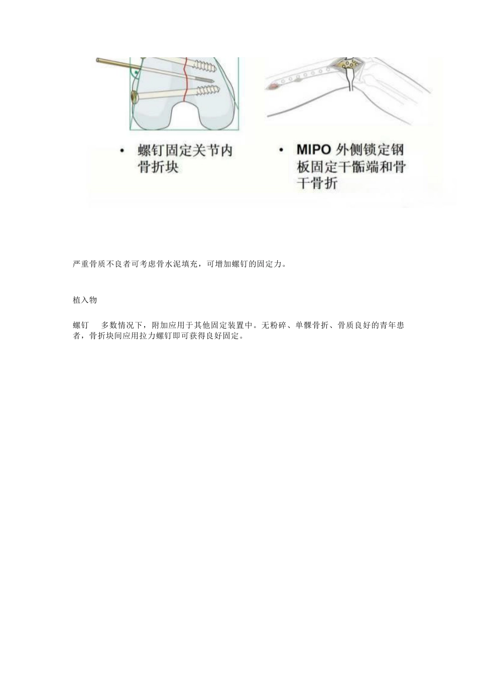 股骨远端骨折---固定方式决定手术成败!_第10页