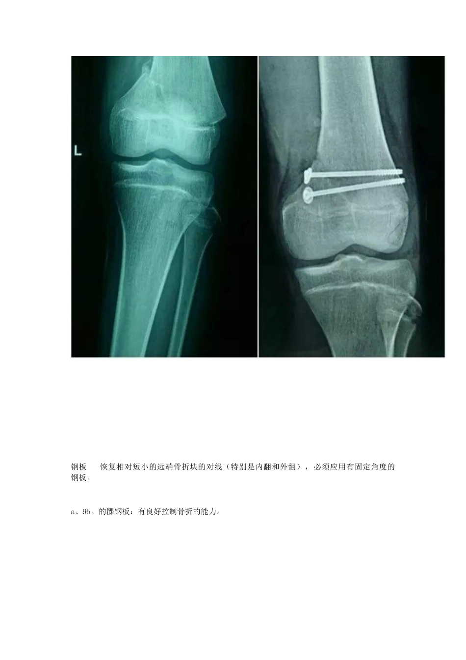 股骨远端骨折---固定方式决定手术成败!_第11页