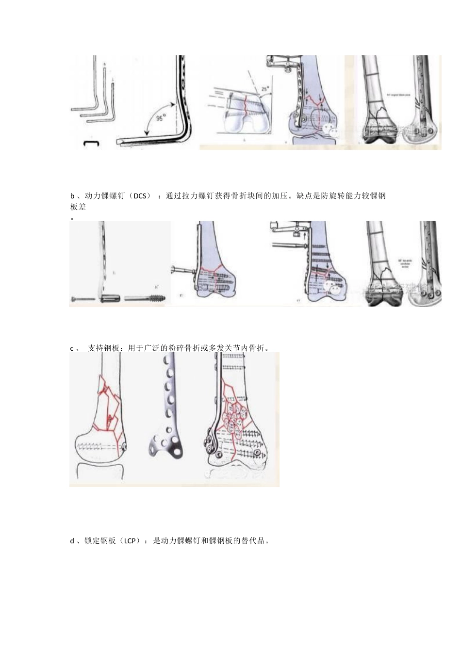 股骨远端骨折---固定方式决定手术成败!_第12页