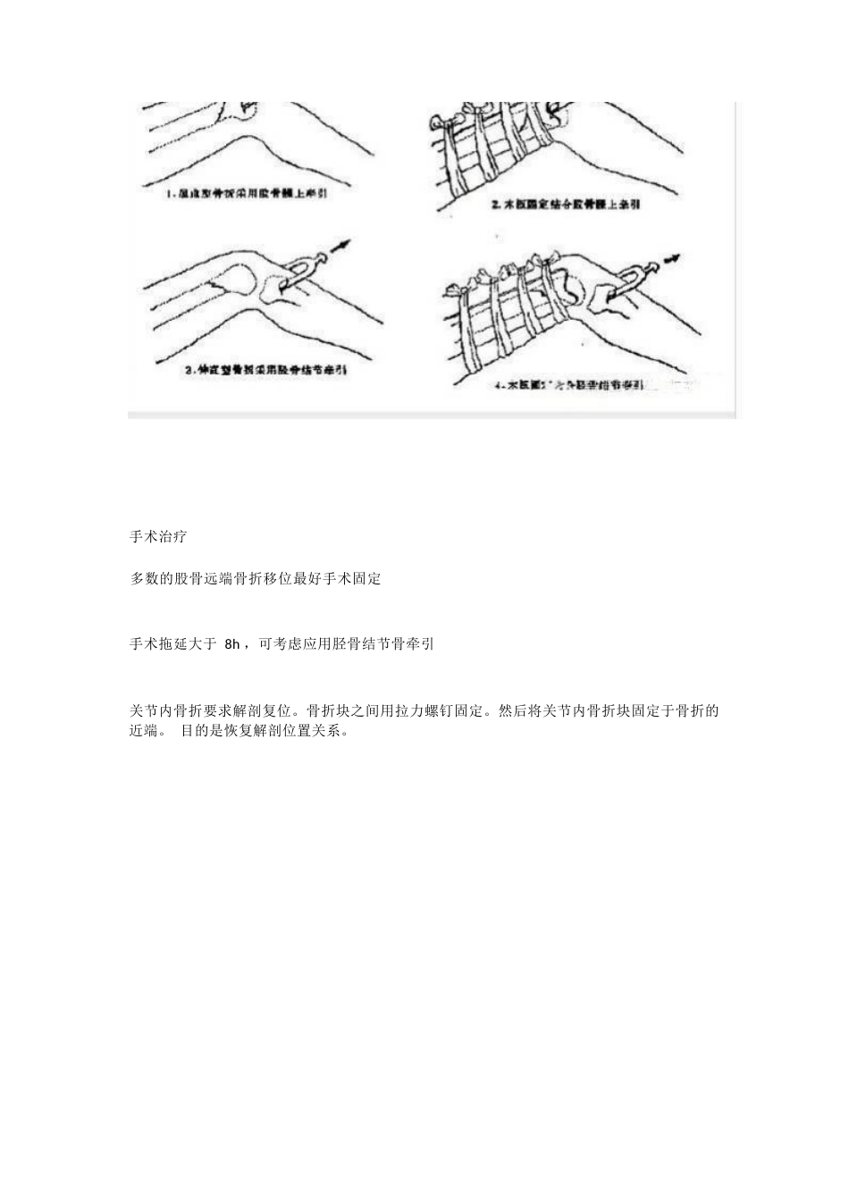 股骨远端骨折---固定方式决定手术成败!_第9页