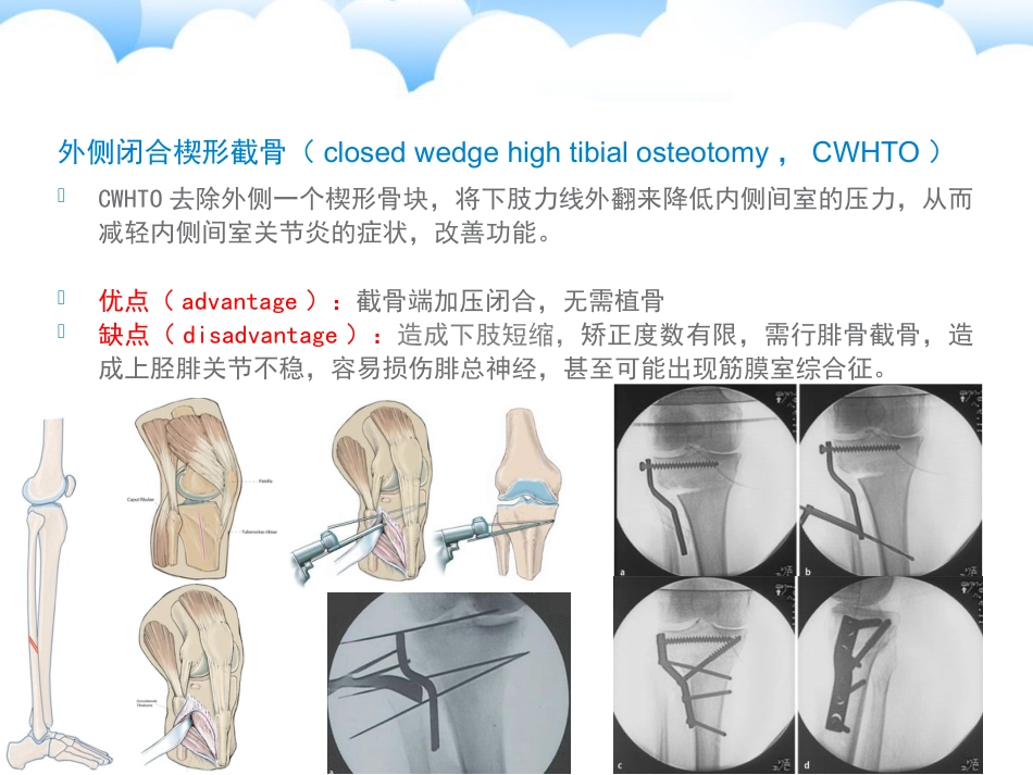胫骨高位截骨术_第14页