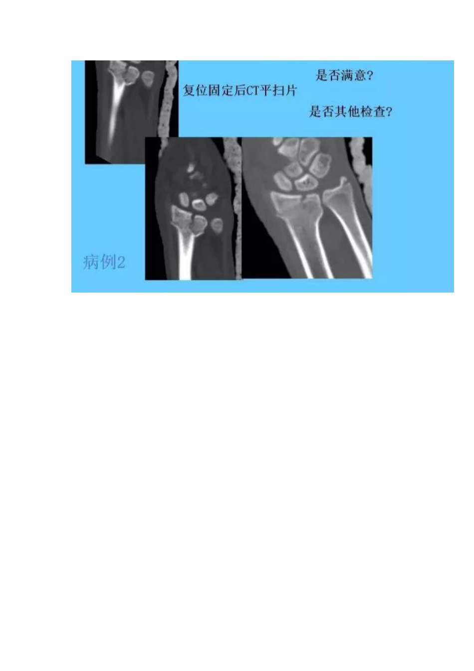 桡骨远端骨折的治疗策略_第10页