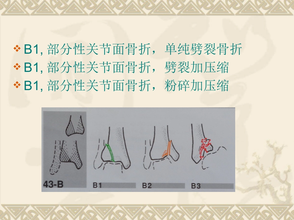 复杂性关节内骨折——pilon骨折治疗_第12页