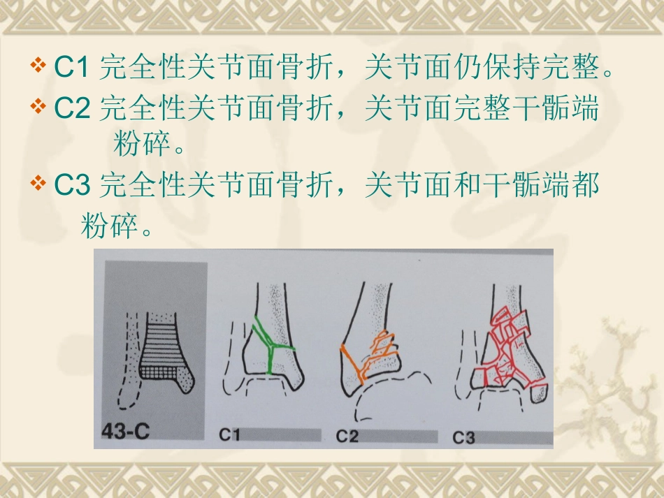 复杂性关节内骨折——pilon骨折治疗_第13页