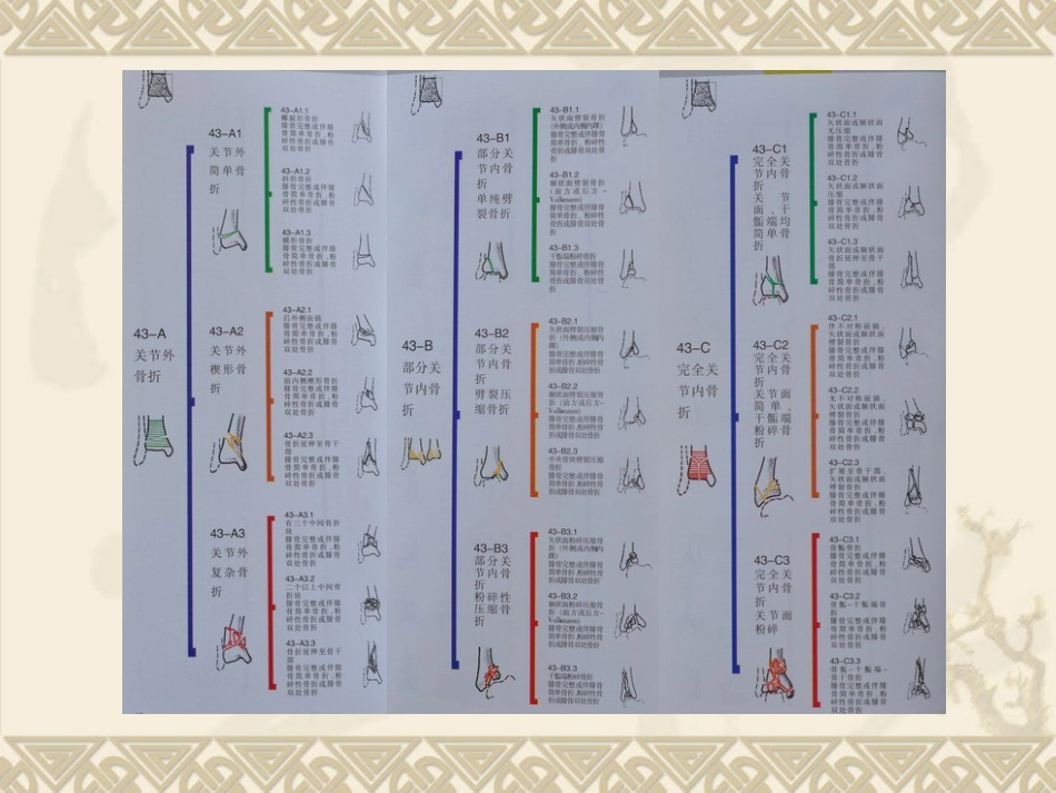 复杂性关节内骨折——pilon骨折治疗_第14页
