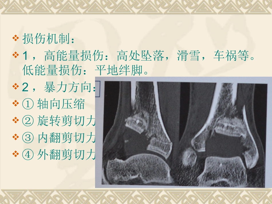 复杂性关节内骨折——pilon骨折治疗_第3页