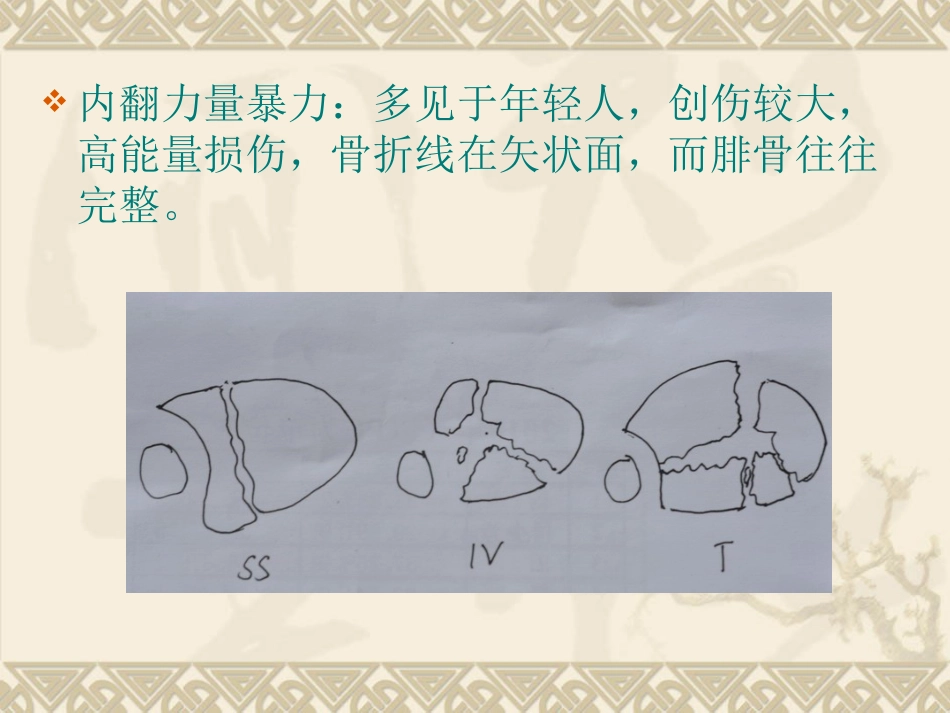 复杂性关节内骨折——pilon骨折治疗_第5页