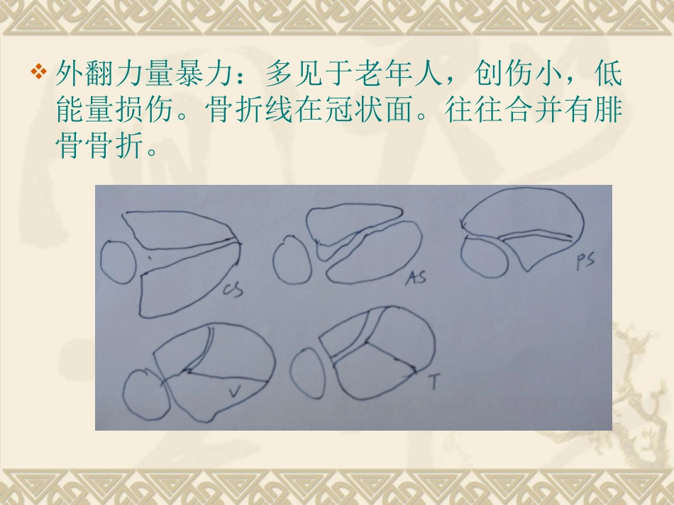 复杂性关节内骨折——pilon骨折治疗_第6页