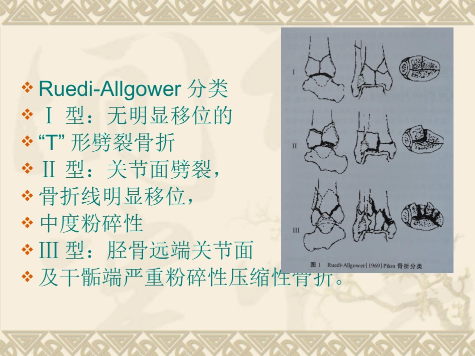 复杂性关节内骨折——pilon骨折治疗_第8页