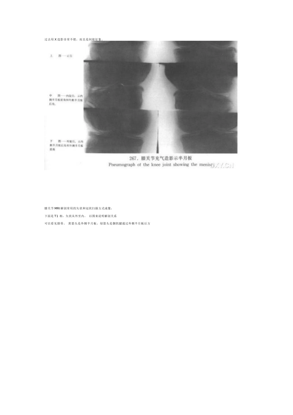 膝关节MRI诊断之正常解剖_第4页