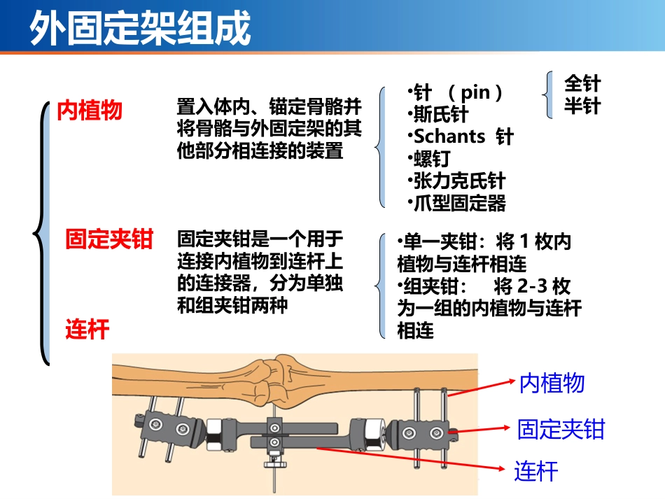 外固定架_第4页