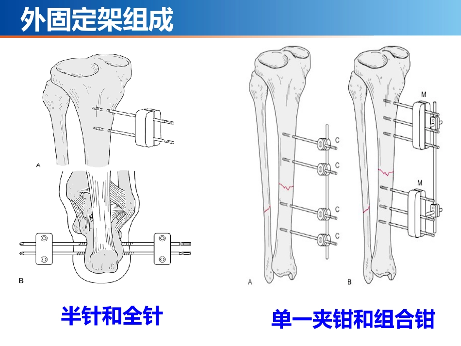 外固定架_第5页