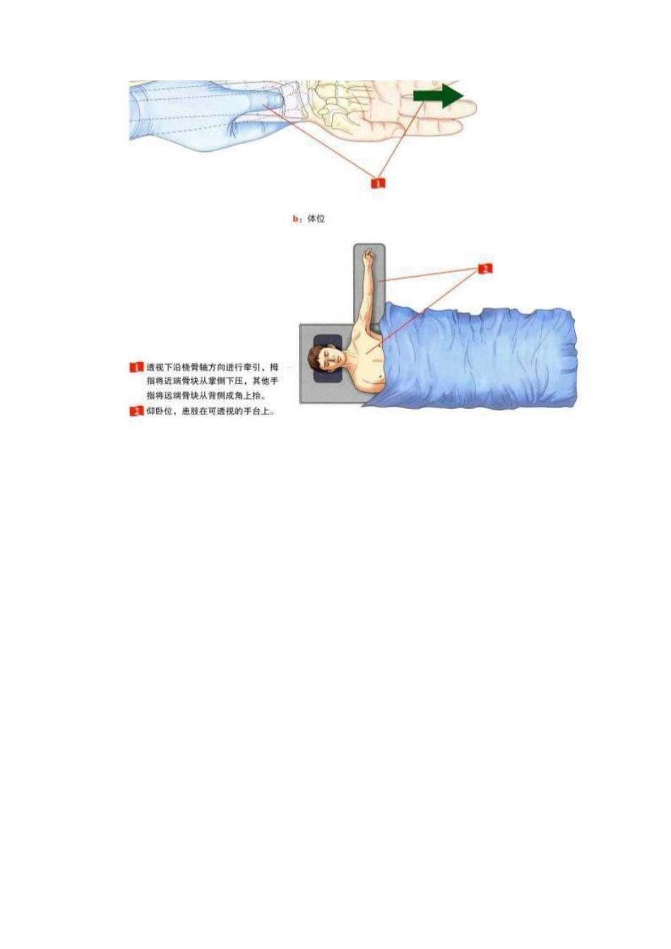 桡骨远端骨折钢板固定的手术技巧_第3页