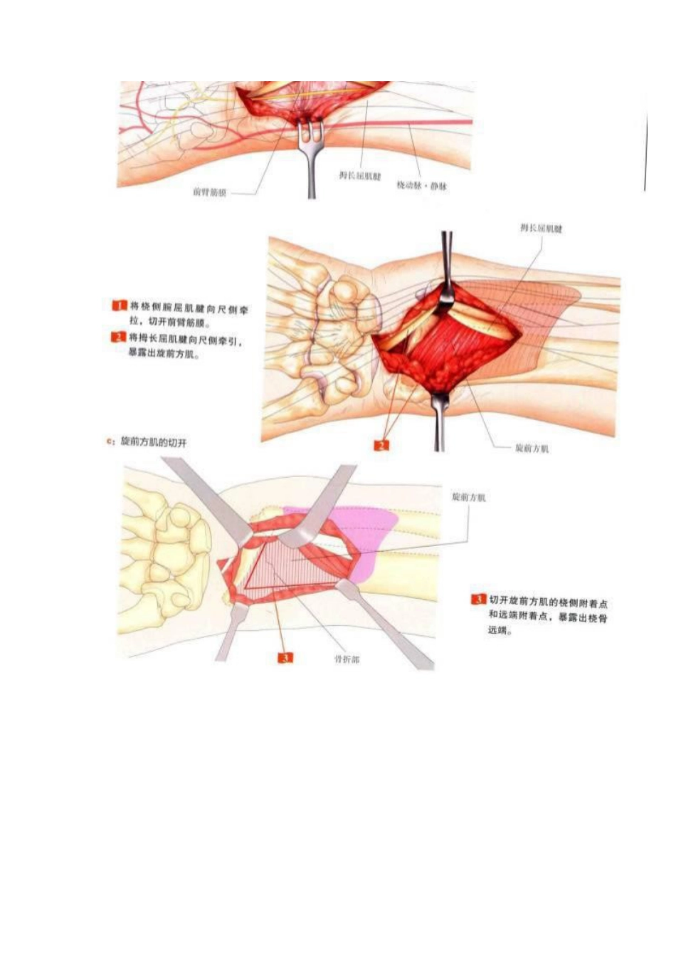 桡骨远端骨折钢板固定的手术技巧_第5页