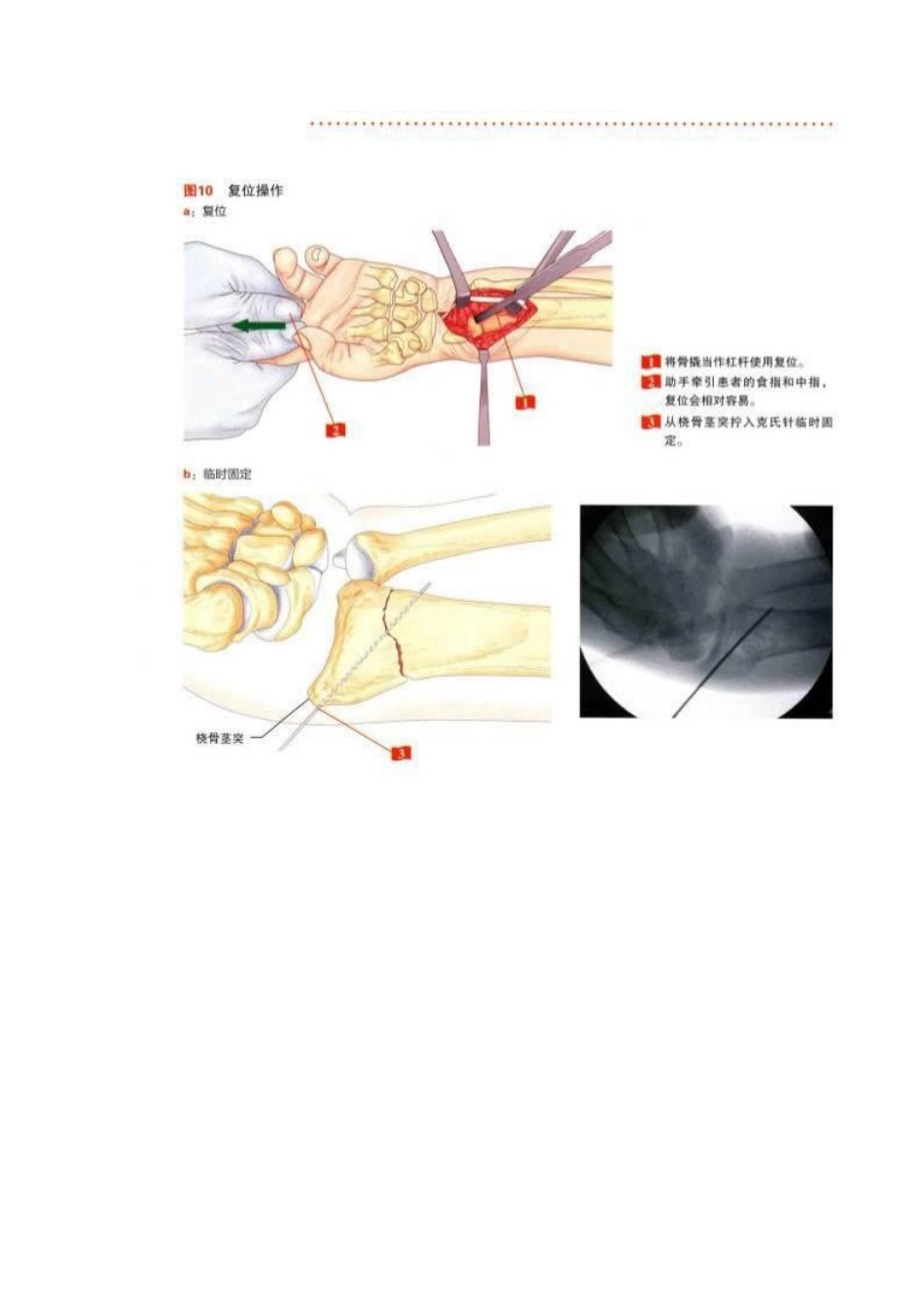 桡骨远端骨折钢板固定的手术技巧_第6页
