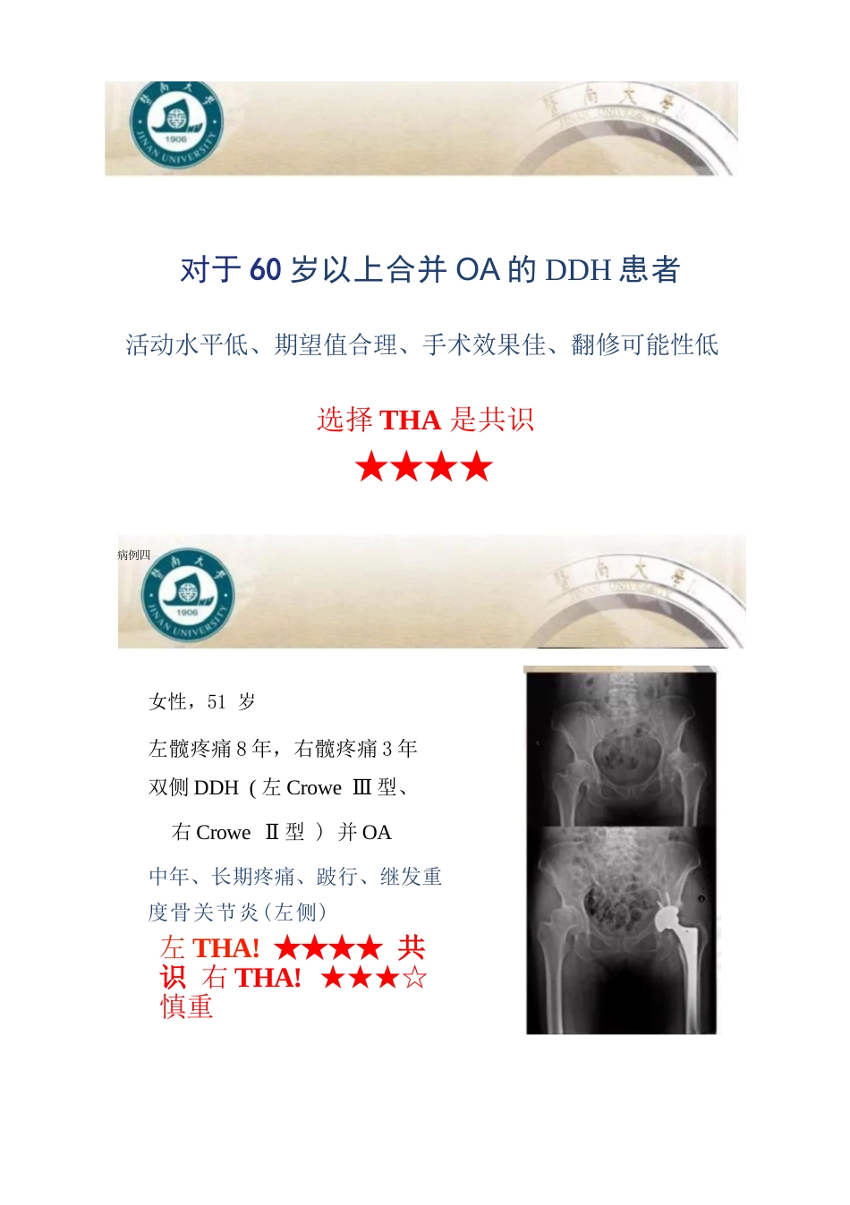 DDH全髋关节置换术的适应症及禁忌症_第5页