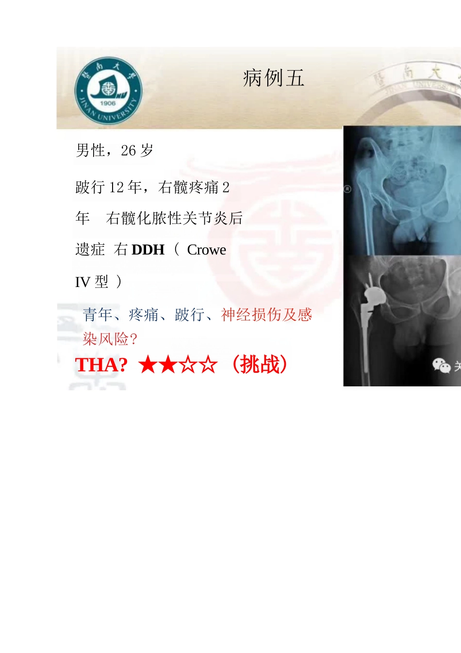 DDH全髋关节置换术的适应症及禁忌症_第7页