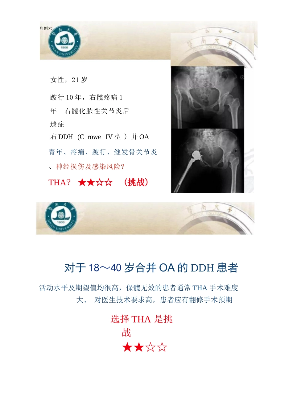 DDH全髋关节置换术的适应症及禁忌症_第8页