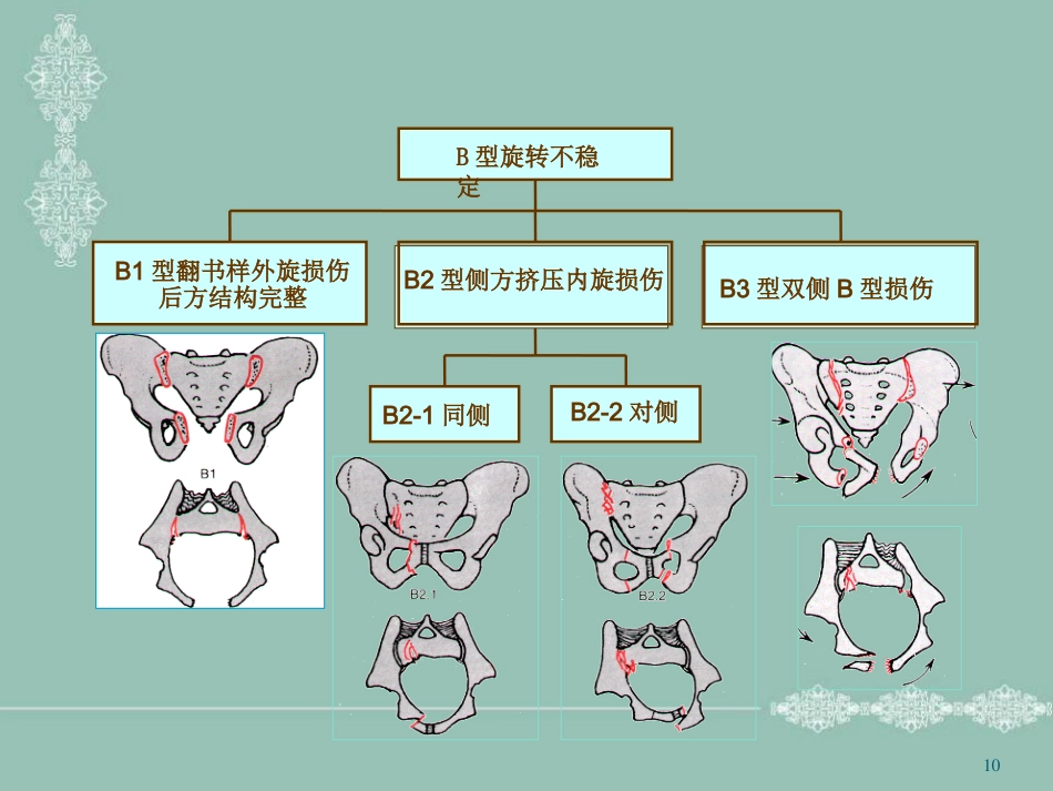 骨盆骨折护理PPT幻灯片_第10页