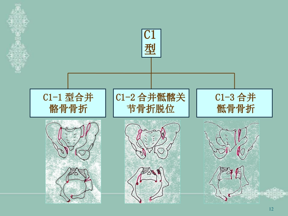 骨盆骨折护理PPT幻灯片_第12页
