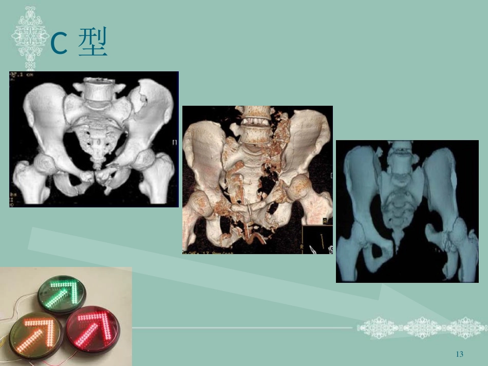 骨盆骨折护理PPT幻灯片_第13页