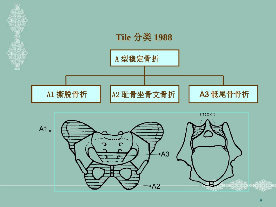 骨盆骨折护理PPT幻灯片_第9页