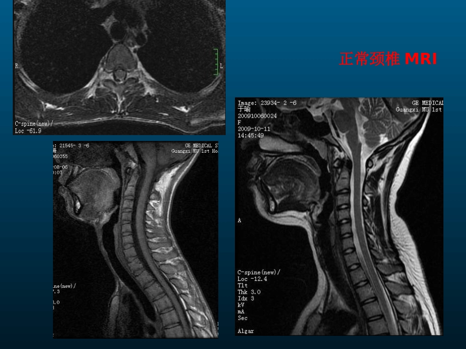 颈椎病的MRI诊断_第10页