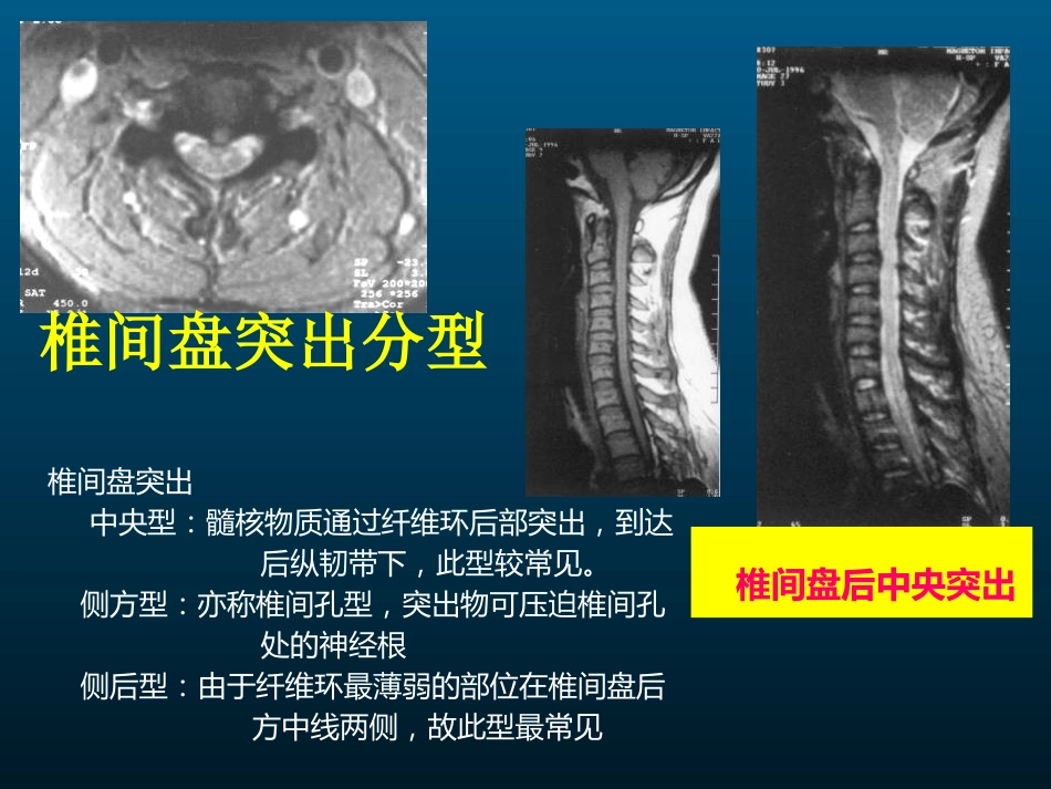 颈椎病的MRI诊断_第15页