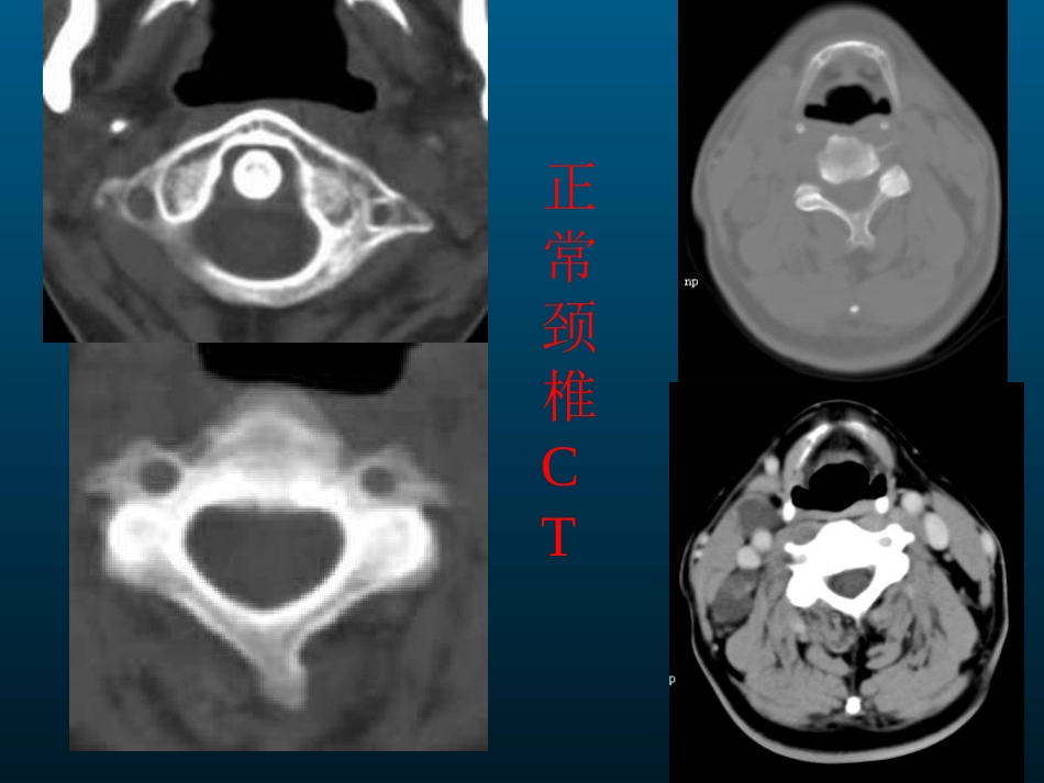 颈椎病的MRI诊断_第7页