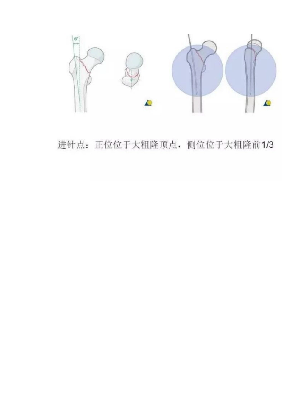 PFNA内固定治疗股骨粗隆间骨折的手术技巧_第10页