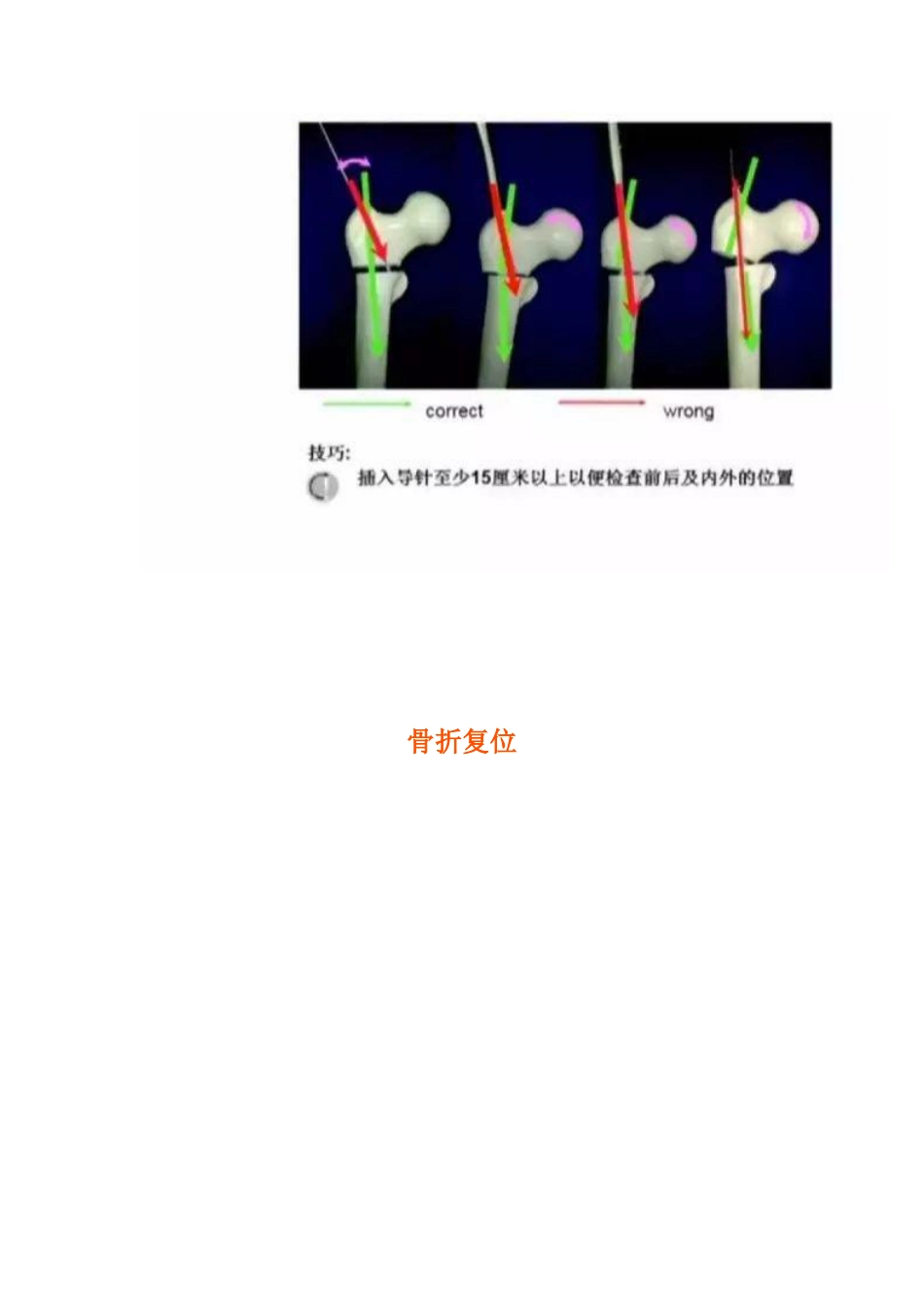 PFNA内固定治疗股骨粗隆间骨折的手术技巧_第11页