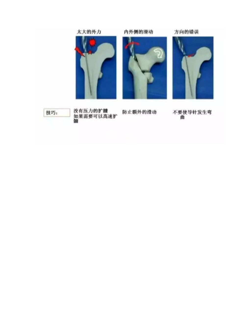 PFNA内固定治疗股骨粗隆间骨折的手术技巧_第12页