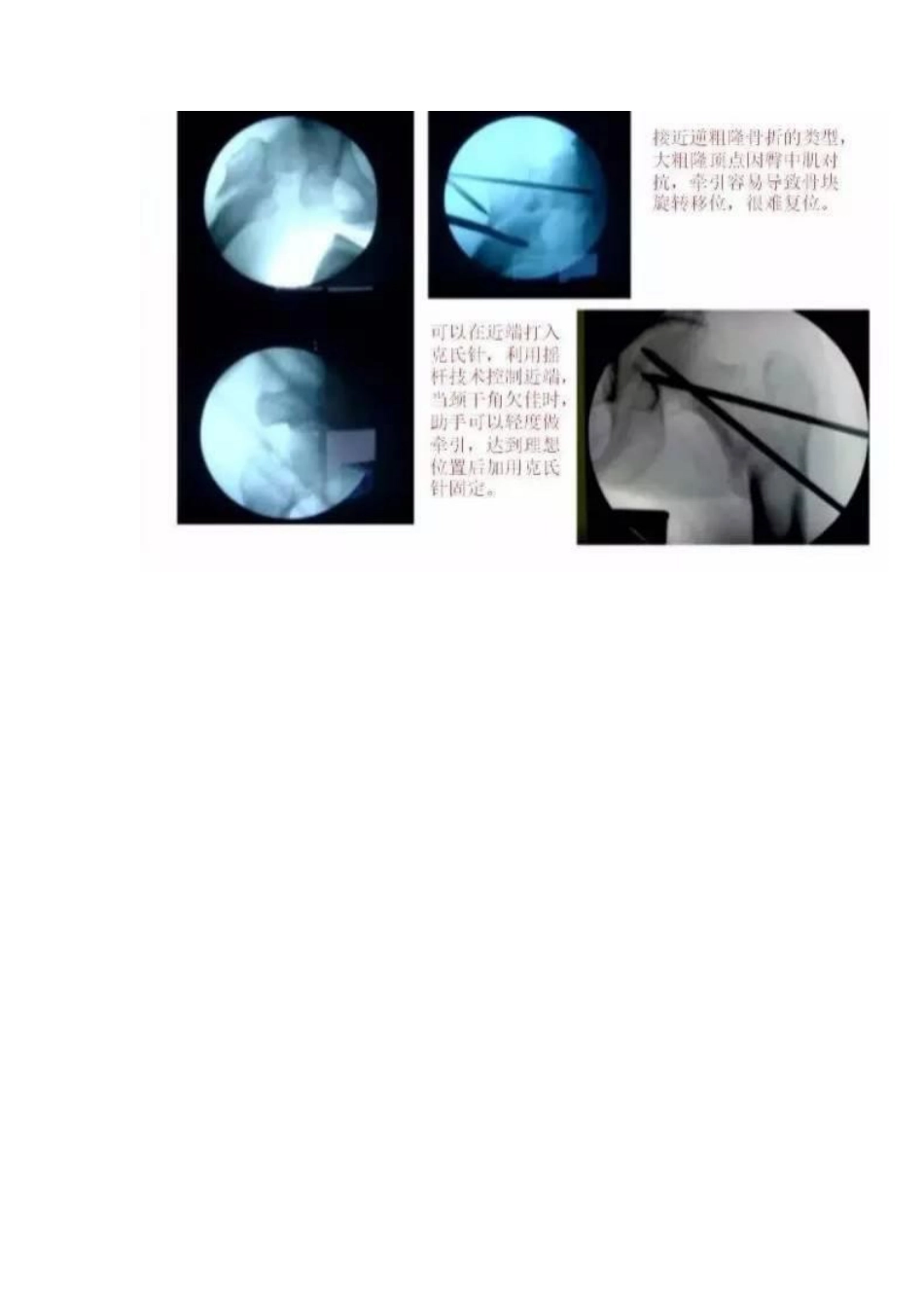 PFNA内固定治疗股骨粗隆间骨折的手术技巧_第13页