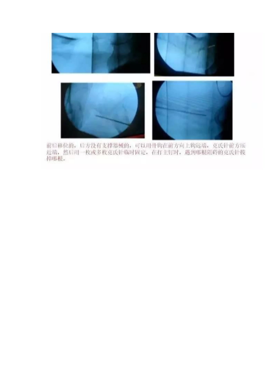 PFNA内固定治疗股骨粗隆间骨折的手术技巧_第14页