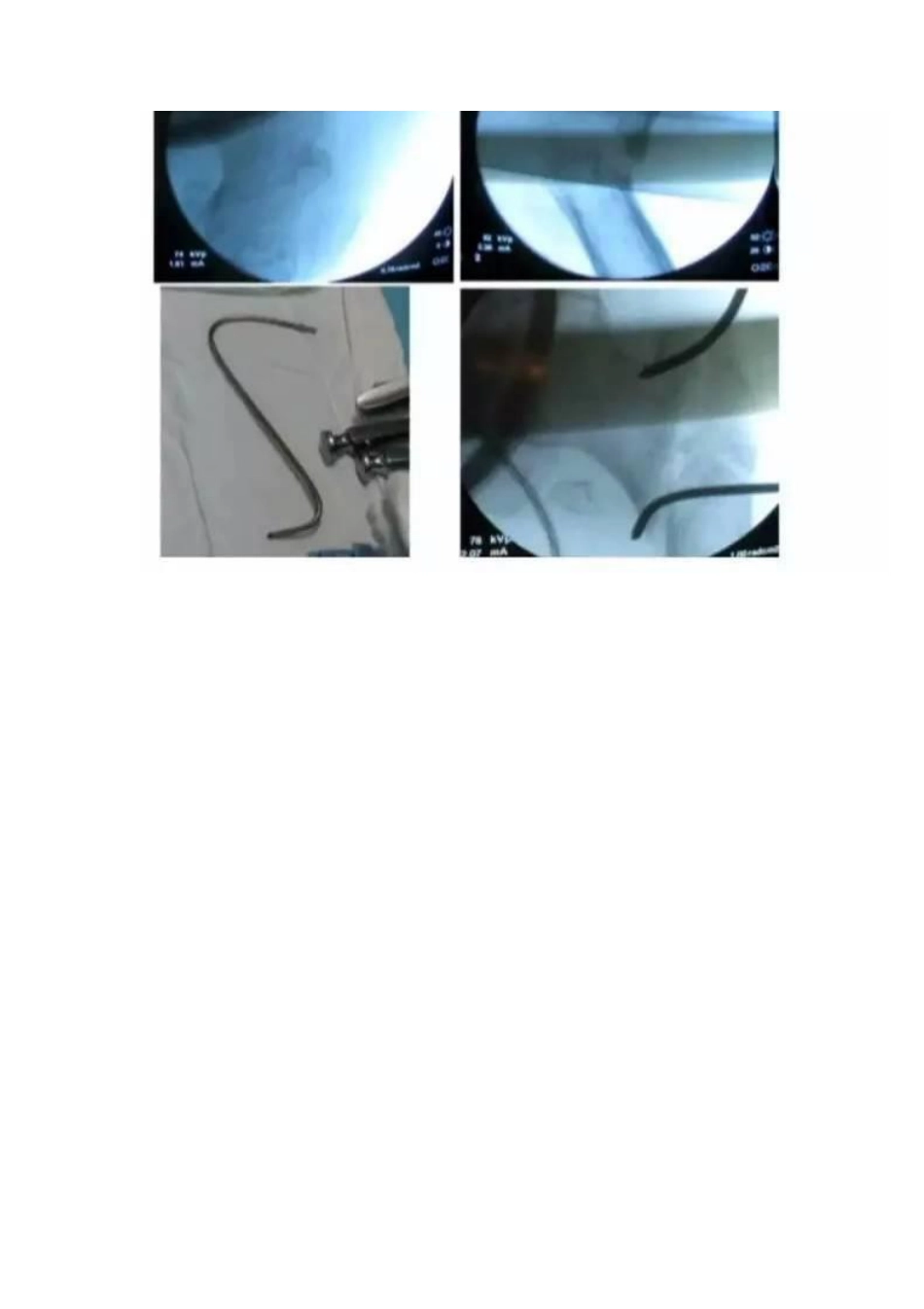 PFNA内固定治疗股骨粗隆间骨折的手术技巧_第15页