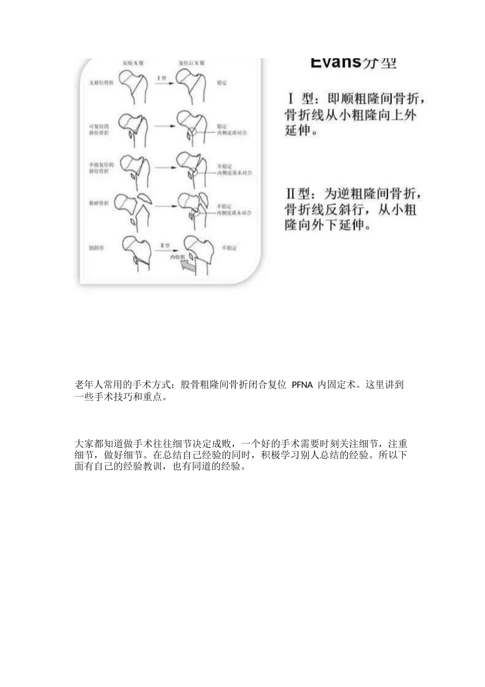 PFNA内固定治疗股骨粗隆间骨折的手术技巧_第2页