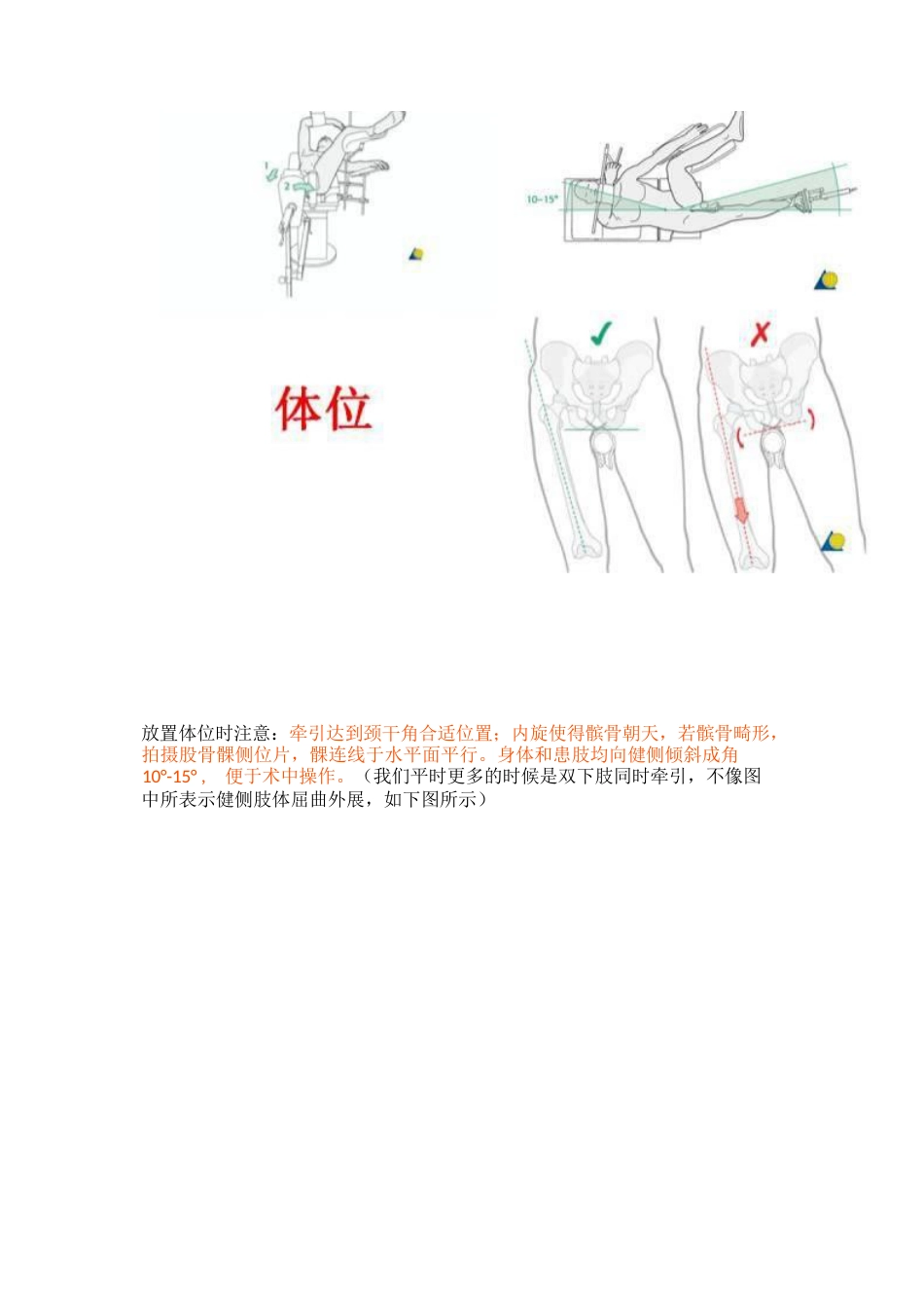 PFNA内固定治疗股骨粗隆间骨折的手术技巧_第3页