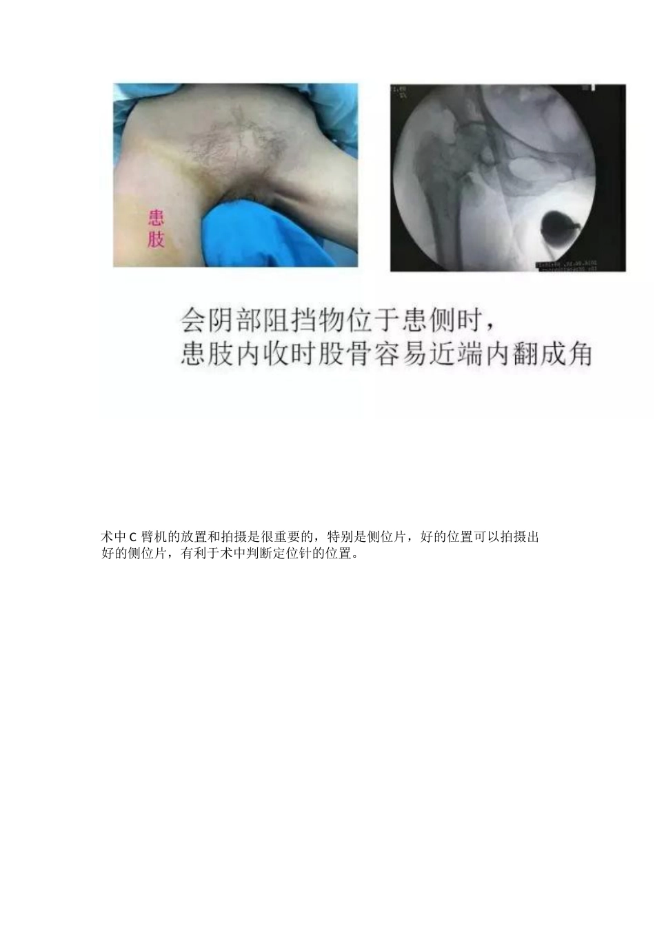 PFNA内固定治疗股骨粗隆间骨折的手术技巧_第6页