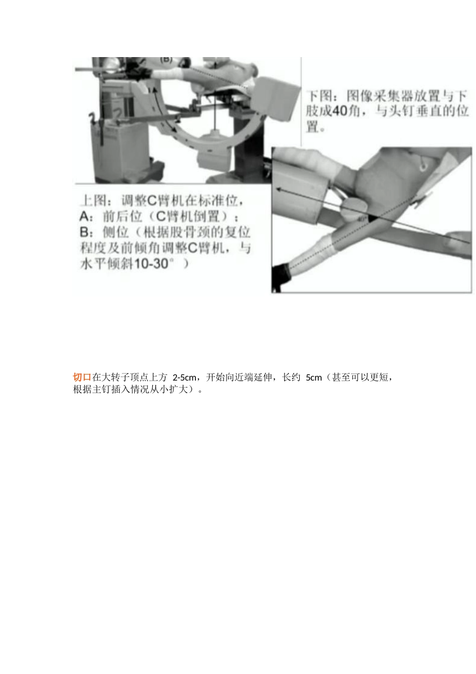 PFNA内固定治疗股骨粗隆间骨折的手术技巧_第7页