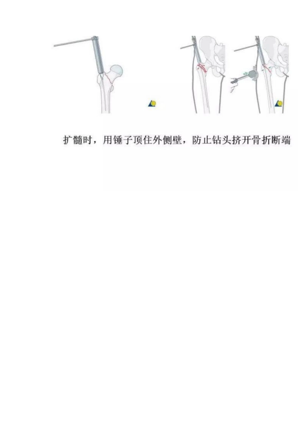 PFNA内固定治疗股骨粗隆间骨折的手术技巧_第9页