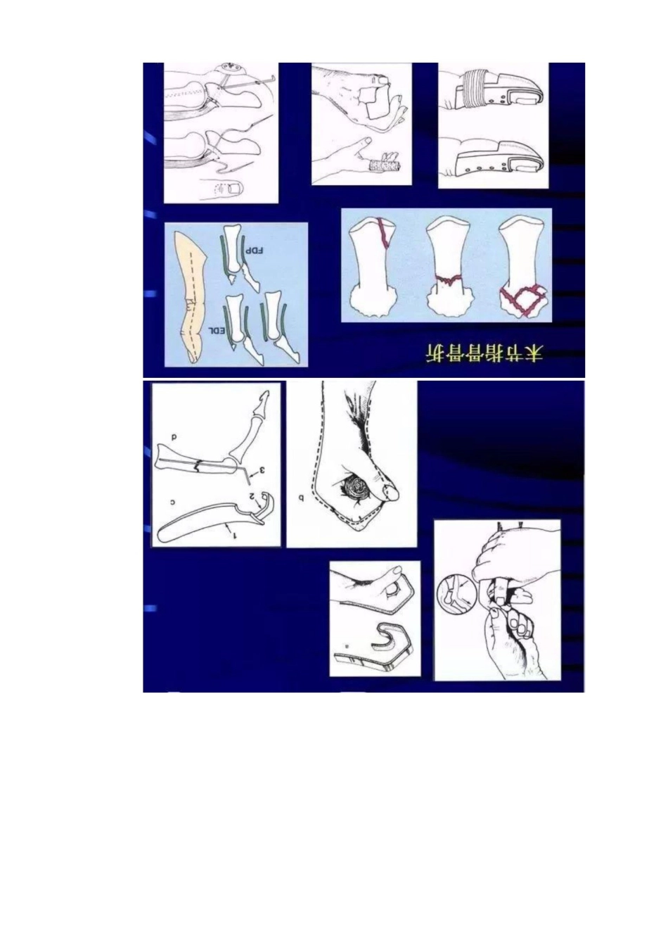 手外伤的常见处理策略及要点_第8页