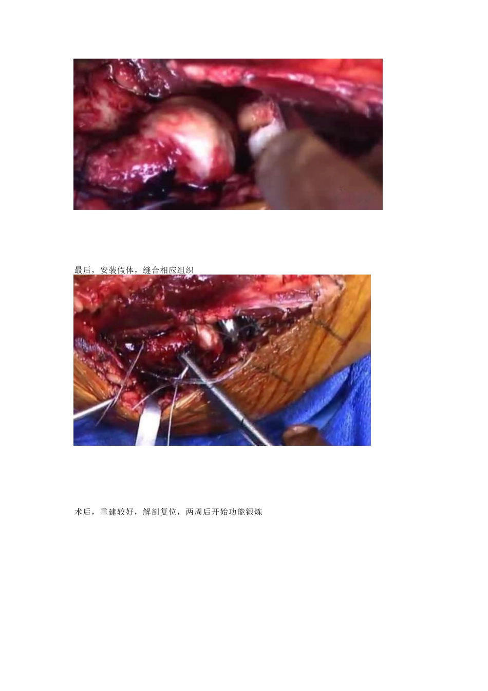 肘关节恐怖三联征治疗策略与技巧_第10页