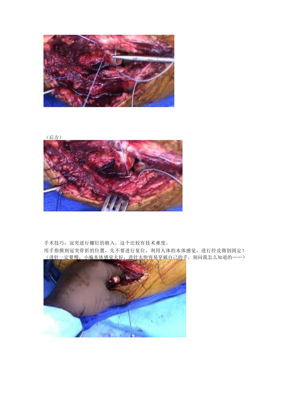 肘关节恐怖三联征治疗策略与技巧_第8页