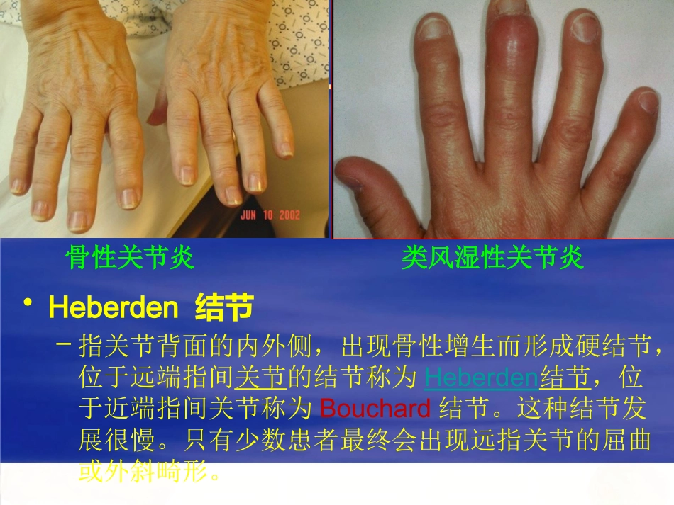 膝关节骨性关节炎的分级治疗_第11页