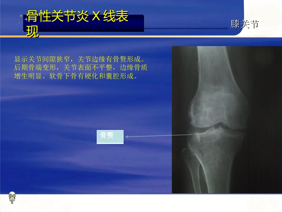 膝关节骨性关节炎的分级治疗_第14页