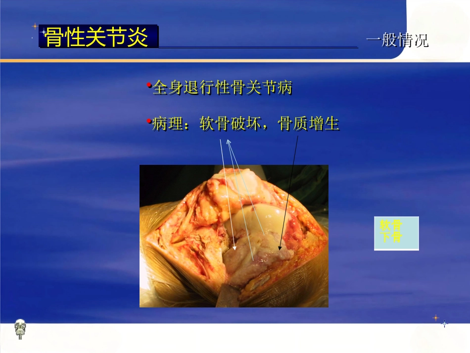 膝关节骨性关节炎的分级治疗_第4页
