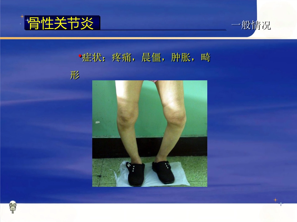 膝关节骨性关节炎的分级治疗_第5页