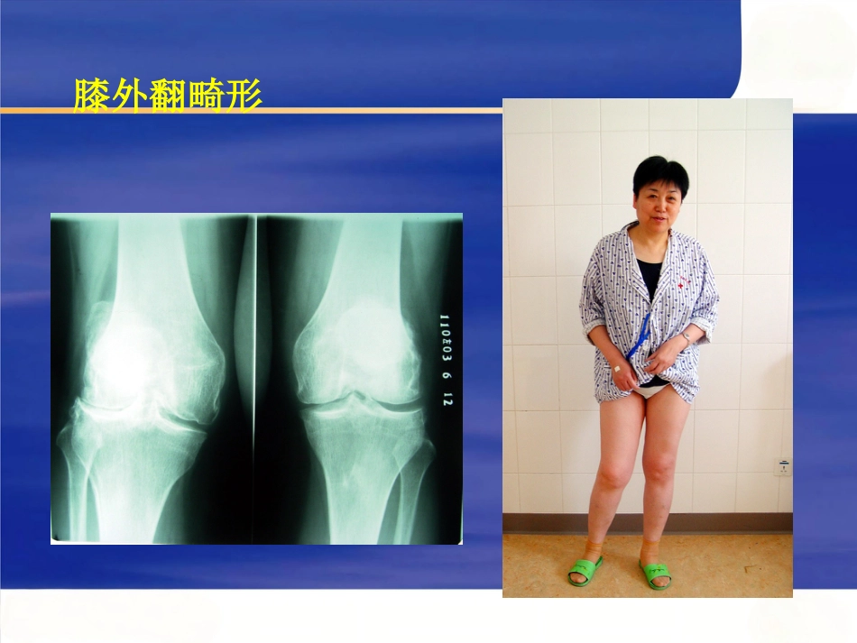 膝关节骨性关节炎的分级治疗_第6页
